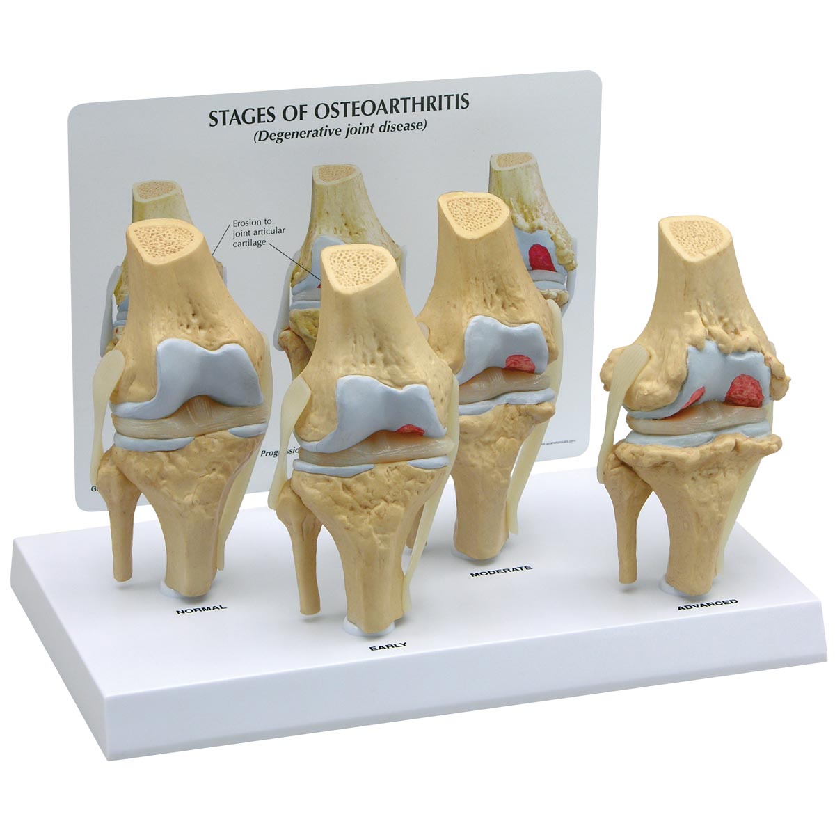 4-stage Osteoarthritis Knee