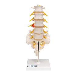 Prolapsmodel, Dorso-lateral